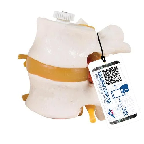 2 Human Lumbar Vertebrae with Prolapsed Disc, Flexibly Mounted – 3B Smart Anatomy – 1000152