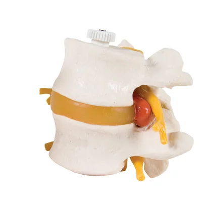 3B Scientific Anatomical Model – 2 Lumbar Vertebrae with prolapsed disc, flexibly mounted – Includes 3B Smart Anatomy – 12-4595