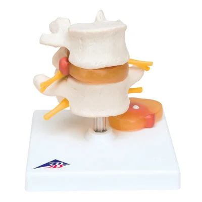 3B Scientific Anatomical Model – Lumbar Spinal Column with Prolapsed Intervertebral Disc – Includes 3B Smart Anatomy – 12-4576