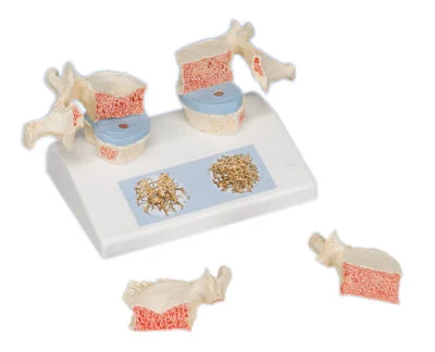 3B Scientific Anatomical Model – osteoporosis model – Includes 3B Smart Anatomy – 12-4544