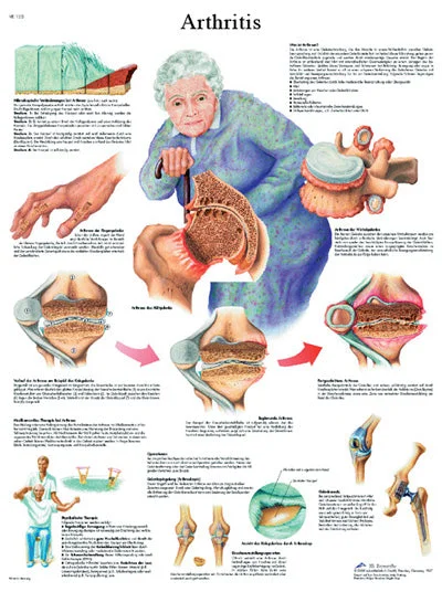 Anatomical Chart – arthritis, paper – 12-4605P