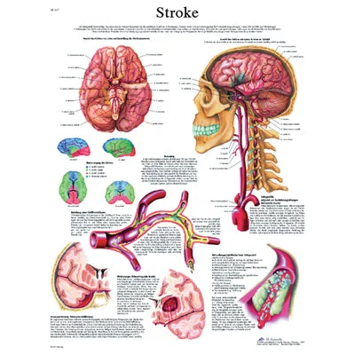 Anatomical Chart – stroke chart, laminated – 12-4629L