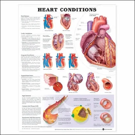 Anatomical Chart Company Anatomical Chart Heart Conditions 20 X 26 Inch Heavy Paper Laminated – 9781587798825