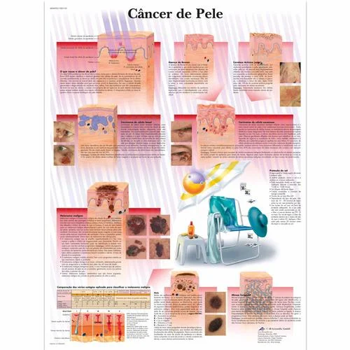 Câncer de Pele – 1002155
