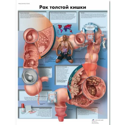 Colon Cancer Chart – 1002292