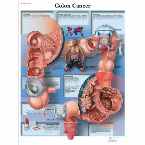 Colon Cancer Chart – 4006692