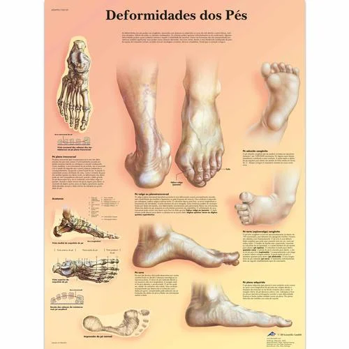 Deformidades do pes, 50×67 cm, Laminado – 1002149