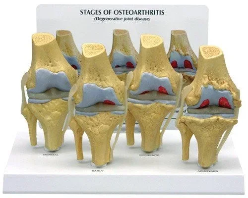 Four Stages of Osteoarthritis Model in The Knee Joint