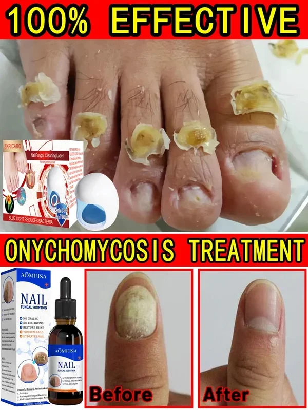 Fungal Nail Laser Device Repair Nails Fungus Onychomycosis