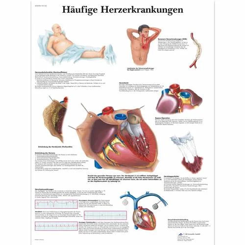 Häufige Herzerkrankungen – 1001362