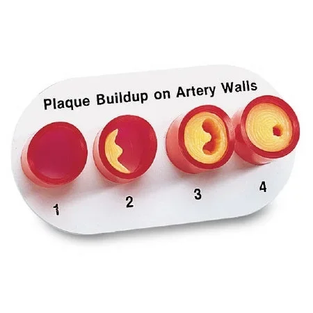 Nasco Artery Sections with Blockage Model – WA09742