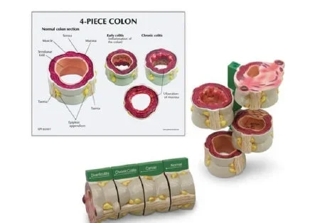 Nasco GPI Anatomicals 4-Piece Colon Model with Pathologies – SB46334G