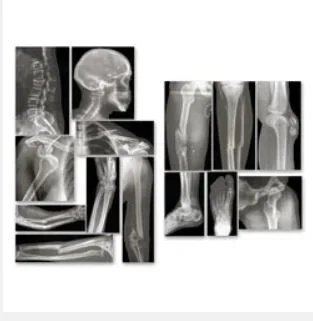Nasco Roylco Broken Bones X-Rays – SB43367