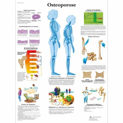 Osteoporose Chart – 1001306