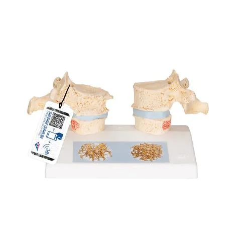 Osteoporosis Didactic Model – 3B Smart Anatomy – 1000182