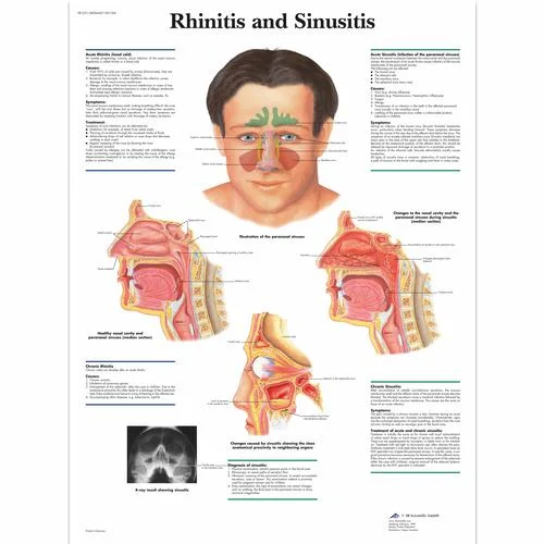 Rhinitis and Sinusitis Chart – 1001504