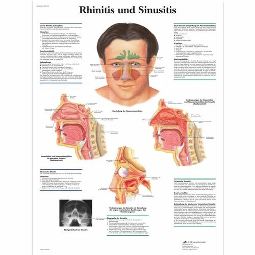 Rhinitis und Sinusitis – 4006586