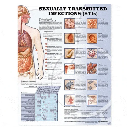 Sexually Transmitted Infections Picture Chart 20 x 26