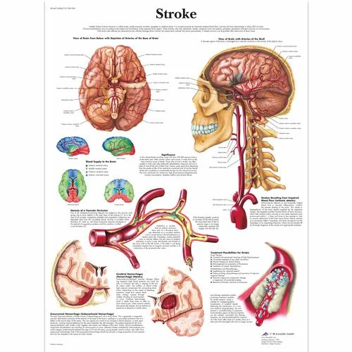 Stroke Chart – 4006712