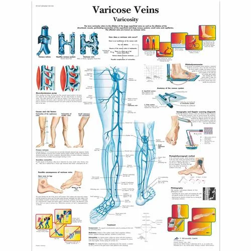 Varicose Veins Chart – 1001534